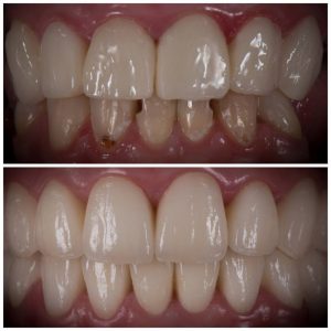restauração dentes estética reparação de dentes dentista vizela clinica del duque rosangela
