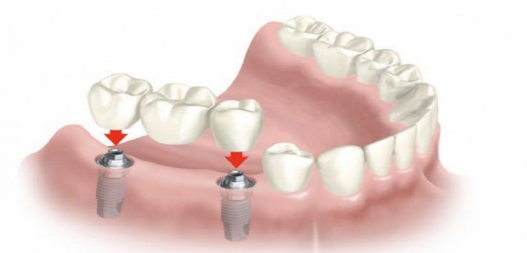  implante dentário vizela preço, dentista, invisalign, coroas, clinica dentária, clinica dentaria, aparelhos dentários, sorriso, branqueamento dentário, ortodontia, ortodontico, aparelhos, dental implante, branqueamento dentário preço, aparelho dentário preços, medicina dentária, desvitalizar dentes, proteses dentária, faceta, facetas dentárias preços, endodontia, tratamentos, odontopediatria, mau hálito, gengival, aparelho transparente, prótese dentária preço, lente dentária, aparelho dentário transparente, goteira de relaxamento, all on 4, facetas dentárias, dentista urgência. pivot, coroas, cárie, cáries, dor de dentes